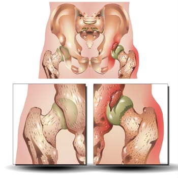 Patients with a posterior dislocation present with a limb adducted, flexed, internally rotated, and shortened.  Vector illustration of a pelvis hip fracture. hip dislocation