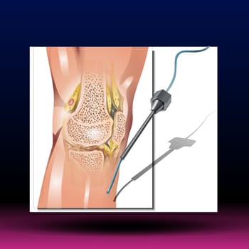Synovial fluid is a thick liquid located between the joints. A synovial fluid analysis checks for disorders that affect the joints. Vector Illustration