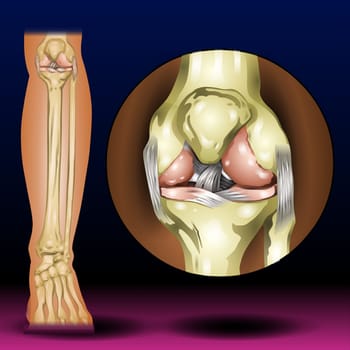 Osgood Schlatter disease condition with leg and knee joint pain, Knee injuries, ligament or muscle trauma, inflammation disease vector illustration