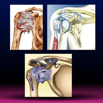 Frozen shoulder occurs when the connective tissue enclosing the joint thickens and tightens. Frozen shoulder, also called adhesive capsulitis, involves stiffness and pain in the shoulder joint. Signs and symptoms typically begin slowly, then get worse. Over time, symptoms get better, usually within 1 to 3 years. Vector Illustration