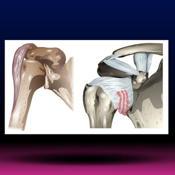 Frozen shoulder occurs when the connective tissue enclosing the joint thickens and tightens. Frozen shoulder, also called adhesive capsulitis, involves stiffness and pain in the shoulder joint. Signs and symptoms typically begin slowly, then get worse. Over time, symptoms get better, usually within 1 to 3 years.