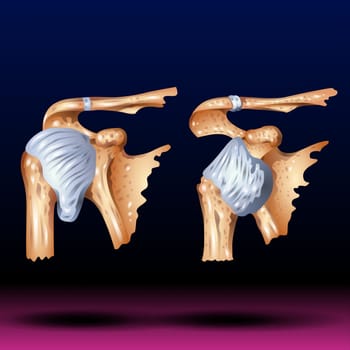 A dislocated shoulder is an injury in which the upper arm bone pops out of the cup-shaped socket that's part of the shoulder blade. The shoulder is the body's most flexible joint, which makes it more likely to dislocate. If you suspect a dislocated shoulder, seek prompt medical attention. Vector Illustration