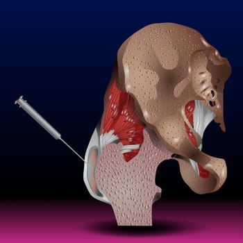 For the acromioclavicular joint, injection may be used for diagnosis and treatment of osteoarthritis and distal clavicular osteolysis.