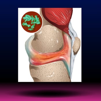 Septic arthritis is a painful infection in a joint that can come from germs that travel through your bloodstream from another part of your body. Septic arthritis can also occur when a penetrating injury, such as an animal bite or trauma, delivers germs directly into the joint.