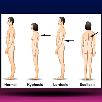 A sideways curvature of the spine. Scoliosis occurs most often during the growth spurt just before puberty. Most cases are mild with few symptoms. Some children develop spine deformities that get more severe as they grow. Severe scoliosis can be painful and disabling. Often, no treatment is necessary. Sometimes a brace or surgery is required. Vector Illustration