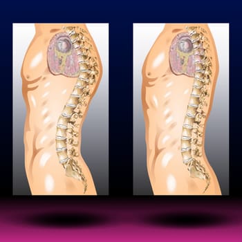 A forward rounding of the back. Hunchback (kyphosis) usually refers to an abnormally curved spine. It's most common in older women and often related to osteoporosis. Some people with kyphosis have back pain and stiffness. Others have no symptoms other than an exaggerated forward rounding of the back. Severe kyphosis can cause pain and be disfiguring. Treatment may include medication for pain, physiotherapy and sometimes surgery. Vector Illustration