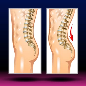 A sideways curvature of the spine. Scoliosis occurs most often during the growth spurt just before puberty. Most cases are mild with few symptoms. Some children develop spine deformities that get more severe as they grow. Severe scoliosis can be painful and disabling. Often, no treatment is necessary. Sometimes a brace or surgery is required.