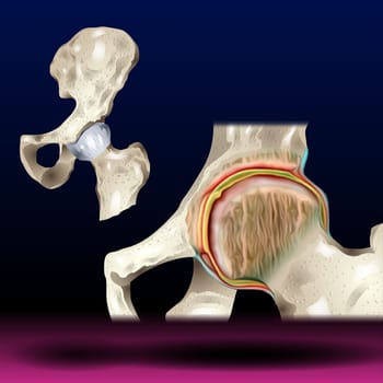 Knee joint with arthritis (Gout , Rheumatoid arthritis , Septic arthritis , Osteoarthritis knee) Vector Illustration