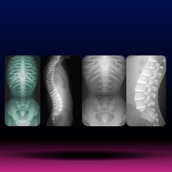 Scoliosis is an abnormal lateral curvature of the spine Vector Illustration