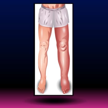 Lymphedema. Lower extremity lymphatic obstruction. Comparison and difference of Healthy leg, and leg with lymphatic insufficiency. Swelling of legs. Overweight problem. elephantiasis. Disorder in the lymphatic system. vector poster