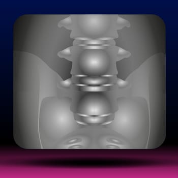 A common, painful condition affecting the lower portion of the spine. Low back pain is caused by injury to a muscle (strain) or ligament (sprain). Common causes include improper lifting, poor posture, lack of regular exercise, a fracture, a ruptured disc or arthritis. Often, the only symptom is pain in the lower back. Most low back pain goes away on its own in two to four weeks. Physiotherapy and pain relievers can help. A few cases may require surgery. Vector Illustration