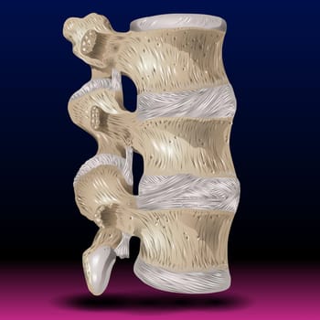 Ankylosing Spondylitis Realistic Vector Medical Chart with Human Vertebral Column Joints Inflammation and Bones Fusion Anatomical Illustration. Spine joint bones arthritis symptoms orthopedic concept.
