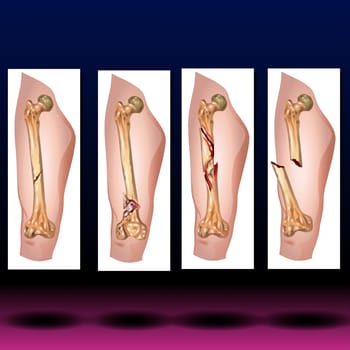 The femur is the longest, strongest bone in your body. It plays an important role in how you stand, move and keep your balance. Femurs usually only break from serious traumas like car accidents. But if your bones are weakened by osteoporosis, you have an increased risk for fractures you might not even know about.