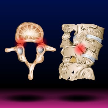 Spondylosis , Spondylolisthesis ( Film x-ray lumbo - sacral spine show spine collapse, decrease in disc space, bony spur formation ) ( side, lateral view ) and blank area