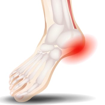 Fractures of the toes and forefoot are quite common. Fractures can result from a direct blow to the foot — such as accidentally kicking something hard or dropping a heavy object on your toes.