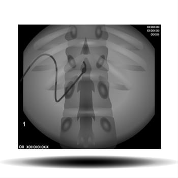 Scoliosis is an abnormal lateral curvature of the spine. Vector Illustration