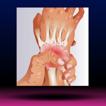 Wrist pain is often caused by sprains or fractures from sudden injuries. But wrist pain can also result from long-term problems, such as repetitive stress, arthritis and carpal tunnel syndrome.