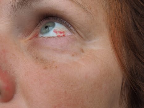 Subconjunctival hemorrhage or subconjunctival bleeding, hyposhagmus. Bleeding under the conjunctiva. Damaged blood vessels. Blood seeps into the space between the conjunctiva and sclera. Grey eyes
