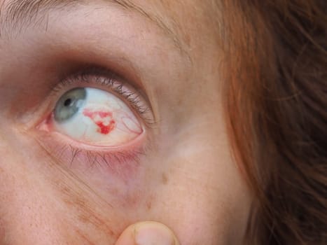 Subconjunctival hemorrhage or subconjunctival bleeding, hyposhagmus. Bleeding under the conjunctiva. Damaged blood vessels. Blood seeps into the space between the conjunctiva and sclera. Grey eyes