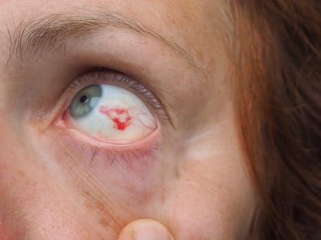 Subconjunctival hemorrhage or subconjunctival bleeding, hyposhagmus. Bleeding under the conjunctiva. Damaged blood vessels. Blood seeps into the space between the conjunctiva and sclera. Grey eyes