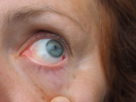 Subconjunctival hemorrhage or subconjunctival bleeding, hyposhagmus. Bleeding under the conjunctiva. Damaged blood vessels. Blood seeps into the space between the conjunctiva and sclera. Grey eyes