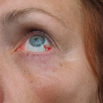 Subconjunctival hemorrhage or subconjunctival bleeding, hyposhagmus. Bleeding under the conjunctiva. Damaged blood vessels. Blood seeps into the space between the conjunctiva and sclera. Grey eyes