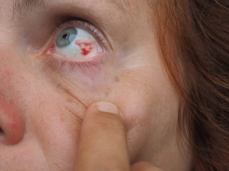 Subconjunctival hemorrhage or subconjunctival bleeding, hyposhagmus. Bleeding under the conjunctiva. Damaged blood vessels. Blood seeps into the space between the conjunctiva and sclera. Grey eyes