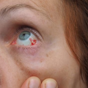 Subconjunctival hemorrhage or subconjunctival bleeding, hyposhagmus. Bleeding under the conjunctiva. Damaged blood vessels. Blood seeps into the space between the conjunctiva and sclera. Grey eyes