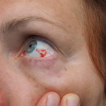 Subconjunctival hemorrhage or subconjunctival bleeding, hyposhagmus. Bleeding under the conjunctiva. Damaged blood vessels. Blood seeps into the space between the conjunctiva and sclera. Grey eyes