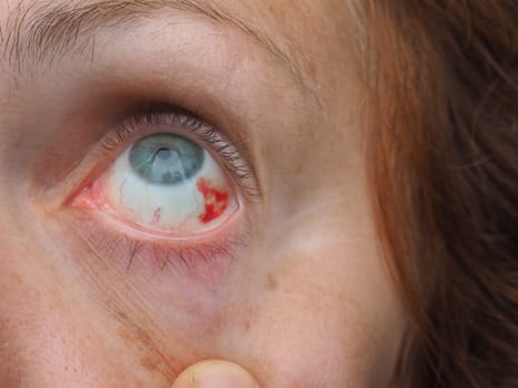 Subconjunctival hemorrhage or subconjunctival bleeding, hyposhagmus. Bleeding under the conjunctiva. Damaged blood vessels. Blood seeps into the space between the conjunctiva and sclera. Grey eyes