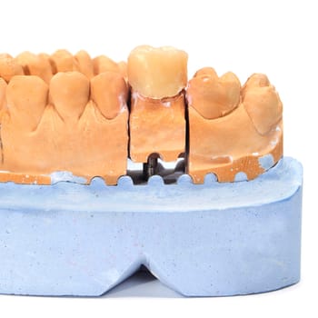 a dental mould with a prosthesis on a white background