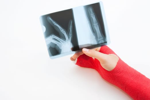 Right hand bandaged in red plaster to support the healing process of broken bone. There is loads of copyspace as the backround is white