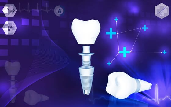 Digital illustration of Dental implant in colour background