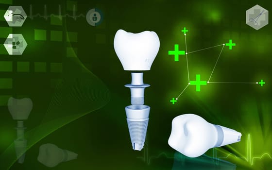 Digital illustration of Dental implant in colour background
