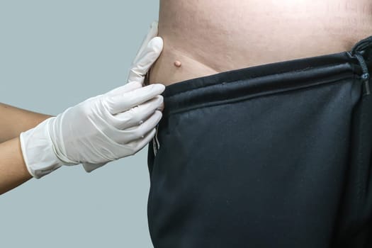 Skin tag or acrochondon or soft fibroma is a safe. It have not effect to the body. It usually occurs at neck, face, armpits and body.
