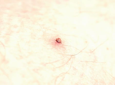 A tick has attached itself to a human leg, macro shot, health care concept, prevention