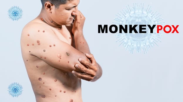 A person with monkeypox on his body, People with monkeypox on isolated background, monkeypox virus concept, monkeypox virus outbreak pandemic design
