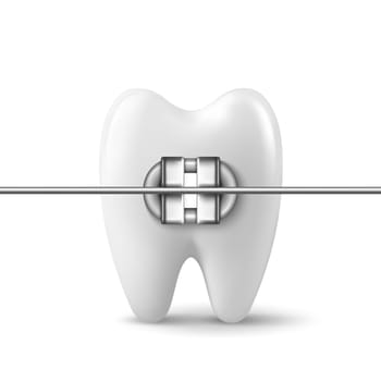 Vector 3d Realistic Tooth with Braces Icon Closeup Isolated on White Background. Medical Dentist Design Template, Clipart. Dental Health Concept.