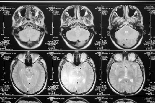 black and white head magnetic resonance image