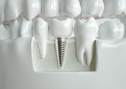 Dental implant nestled between two healthy teeth, depicted in a cross-section through the jaw.