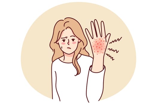 Unhappy woman suffer from redness on hand. Unwell girl struggle with psoriasis or seasonal allergy. Healthcare concept. Vector illustration.