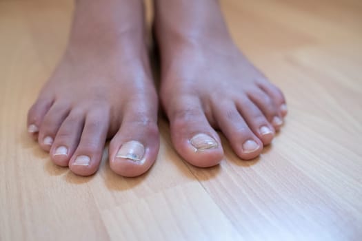 Selective focus of a young boy's feet standing on a wooden floor. The growth phase of the nail of the left big toe after an accidental break is shown. The nail on the big toe of the right foot has a small subungual hematoma due to wearing inappropriate shoes.