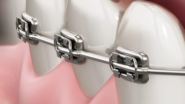 Illustration showing dental braces on straight teeth. 3D illustration.