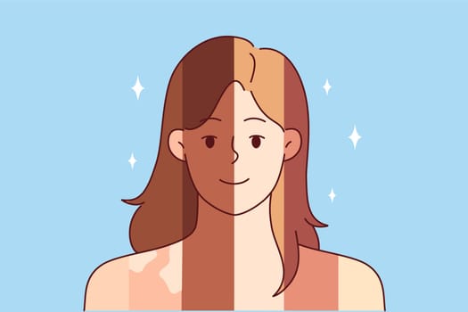 Woman with different skin colors and vitiligo spots on body symbolizes difference between people and racial tolerance. Concept of unity of different races and ethnicities and lack of discrimination