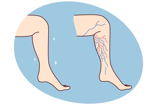 Close-up of unhealthy and healthy leg with varicose veins. Patient suffer from varicoses. Healthcare and medicine. Vector illustration.