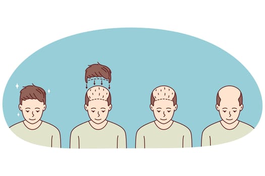 Stages on man hair transplant. Treatment of baldness and alopecia. Set of male patient follicular unit extraction. Vector illustration.