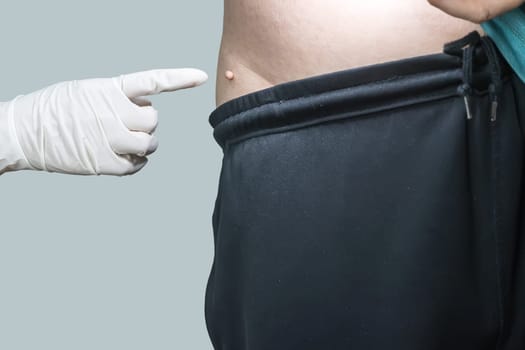 Skin tag or acrochondon or soft fibroma is a safe. It have not effect to the body. It usually occurs at neck, face, armpits and body.
