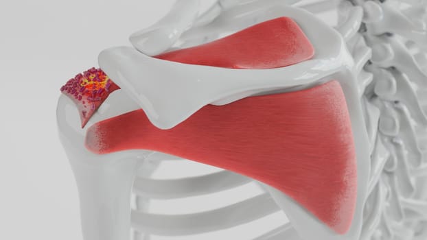 A simplified 3D rendering of a shoulder joint with basic colors and textures to highlight areas of calcific tendonitis.