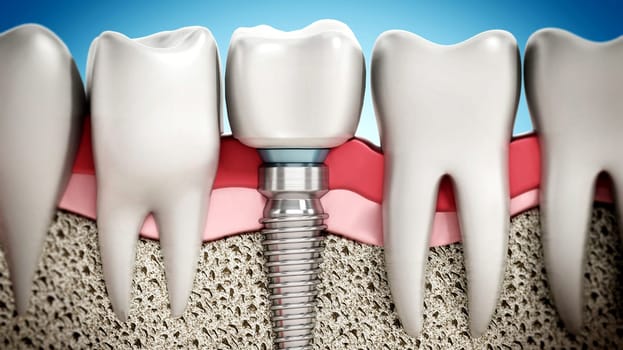 3D rendering of tooth implant showing jaw gum and bone layers. 3D illustration.