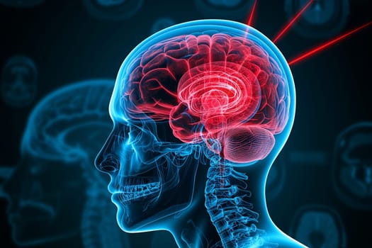 Human brain x-ray, epilepsy, migraine headache attack, psychological pressure and stress, mind with burnout or trauma